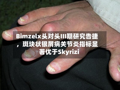 Bimzelx头对头III期研究告捷	，斑块状银屑病关节炎指标显著优于Skyrizi-第2张图片