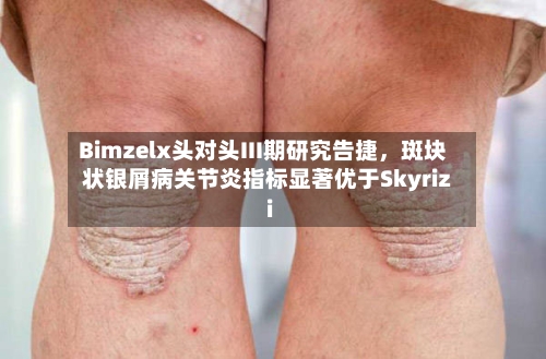 Bimzelx头对头III期研究告捷，斑块状银屑病关节炎指标显著优于Skyrizi-第3张图片