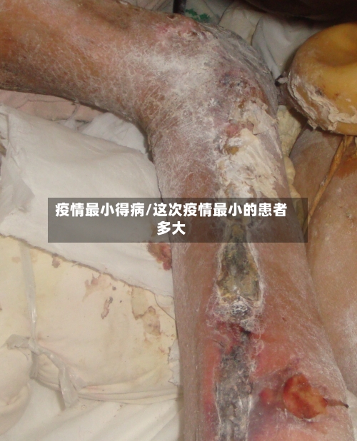 疫情最小得病/这次疫情最小的患者多大
